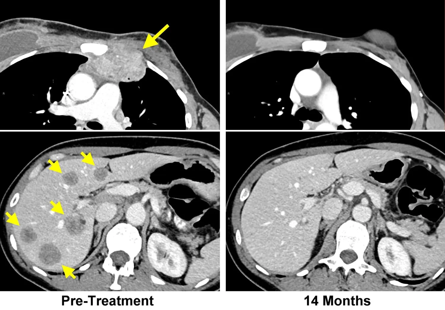 Cancer MRI Scans (28750336678)